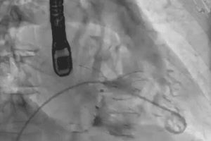 « Des perspectives importantes dans le domaine de la cardiologie interventionnelle structurelle »